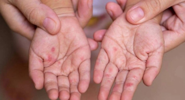 Banqladeşdə qızılca epidemiyası dərinləşir: Uşaqlar arasında ölüm sayı 712-yə yüksəldi